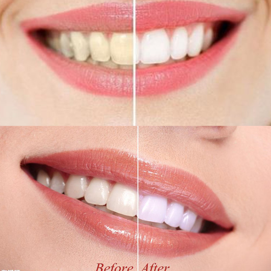 Bambu kömür diş diş diş hekimi - Teeth Whitening Quotes incelemesi ve fiyatı