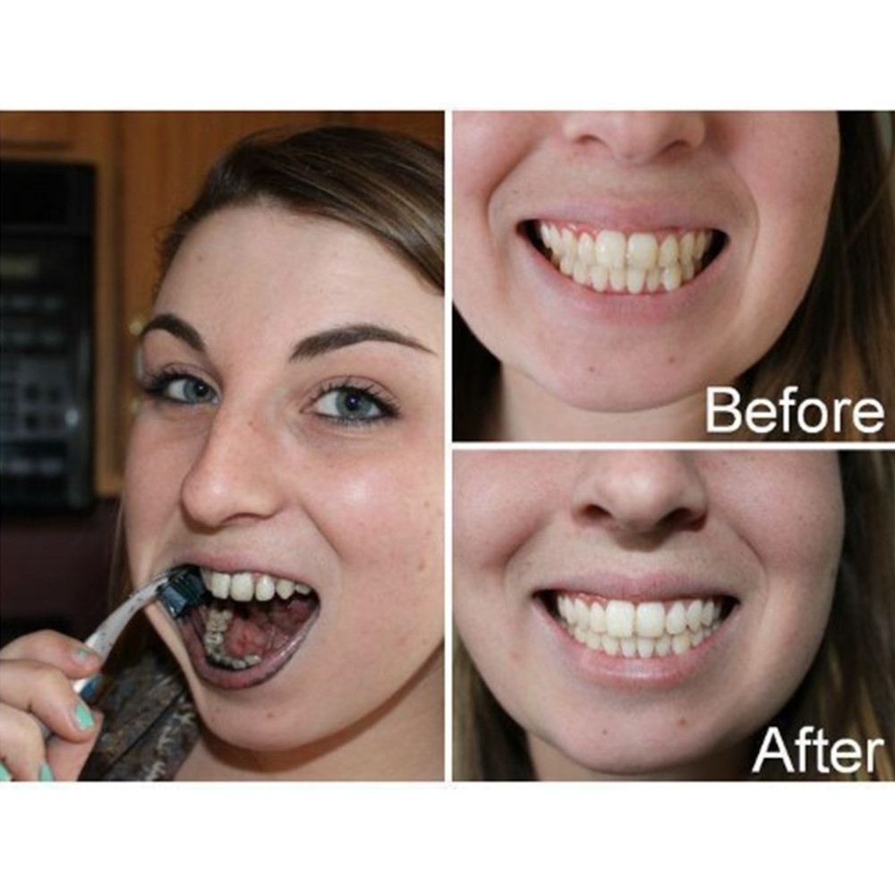 Bambu kömür diş diş diş hekimi - Teeth Whitening Quotes incelemesi ve fiyatı