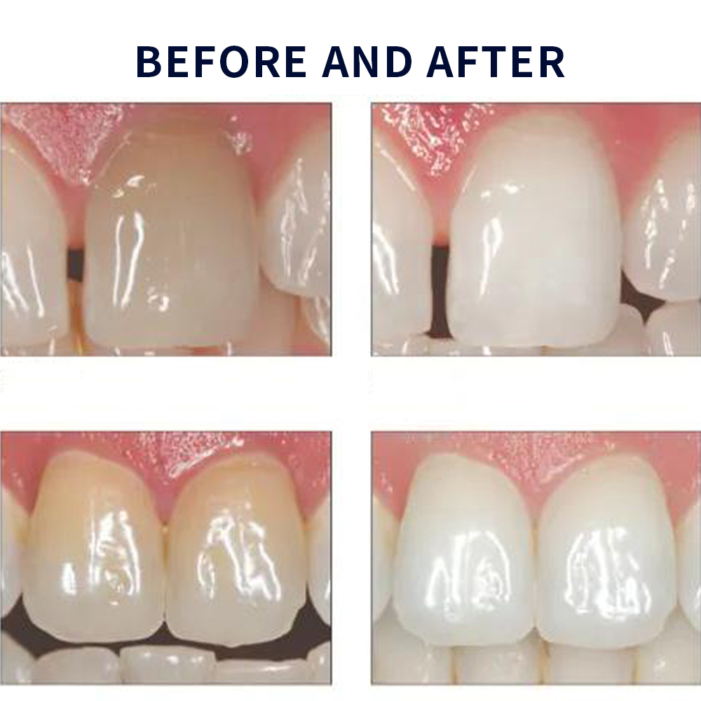 Opalescence beyazlatma 20% PF  - Teeth Whitening Gels Used By Dentists incelemesi ve fiyatı