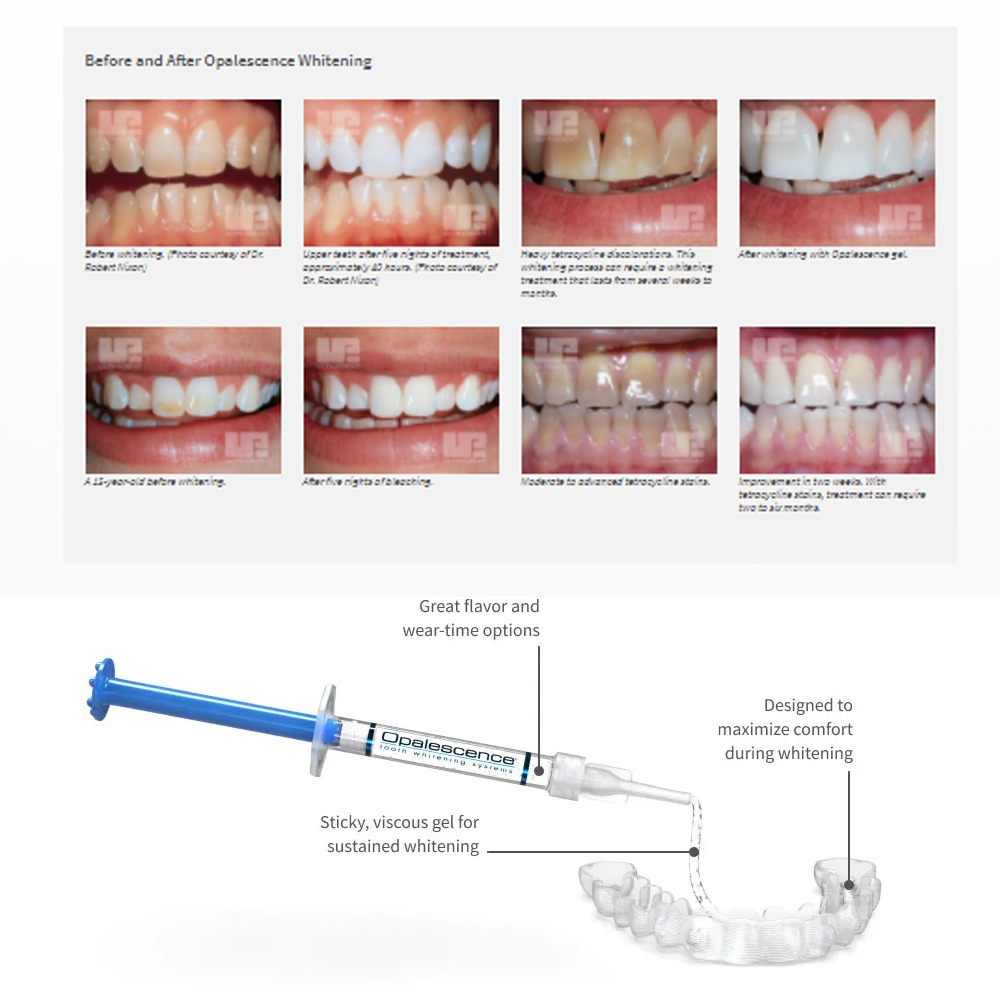 Opalescence beyazlatma 20% PF  - Teeth Whitening Gels Used By Dentists incelemesi ve fiyatı