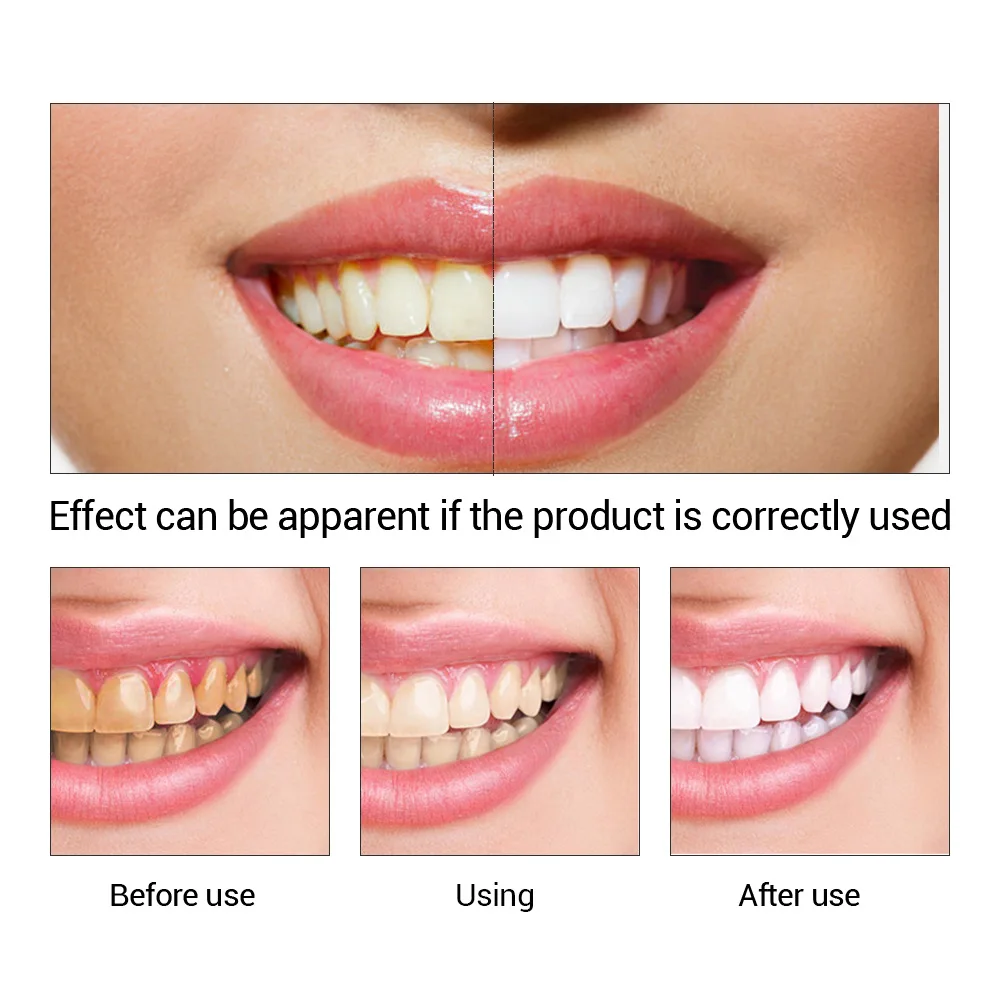 FTEENPLY diş beyazlatma özü to - Teeth Whitening Quotes incelemesi ve fiyatı