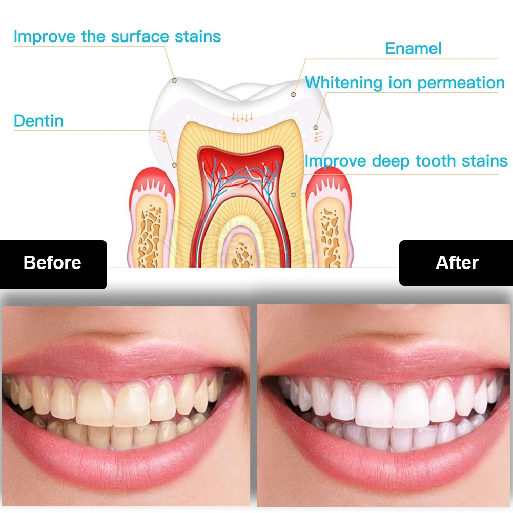 Diş Diş Beyazlatma Kiti Mini 1 - Teeth Whitening Light Kit incelemesi ve fiyatı